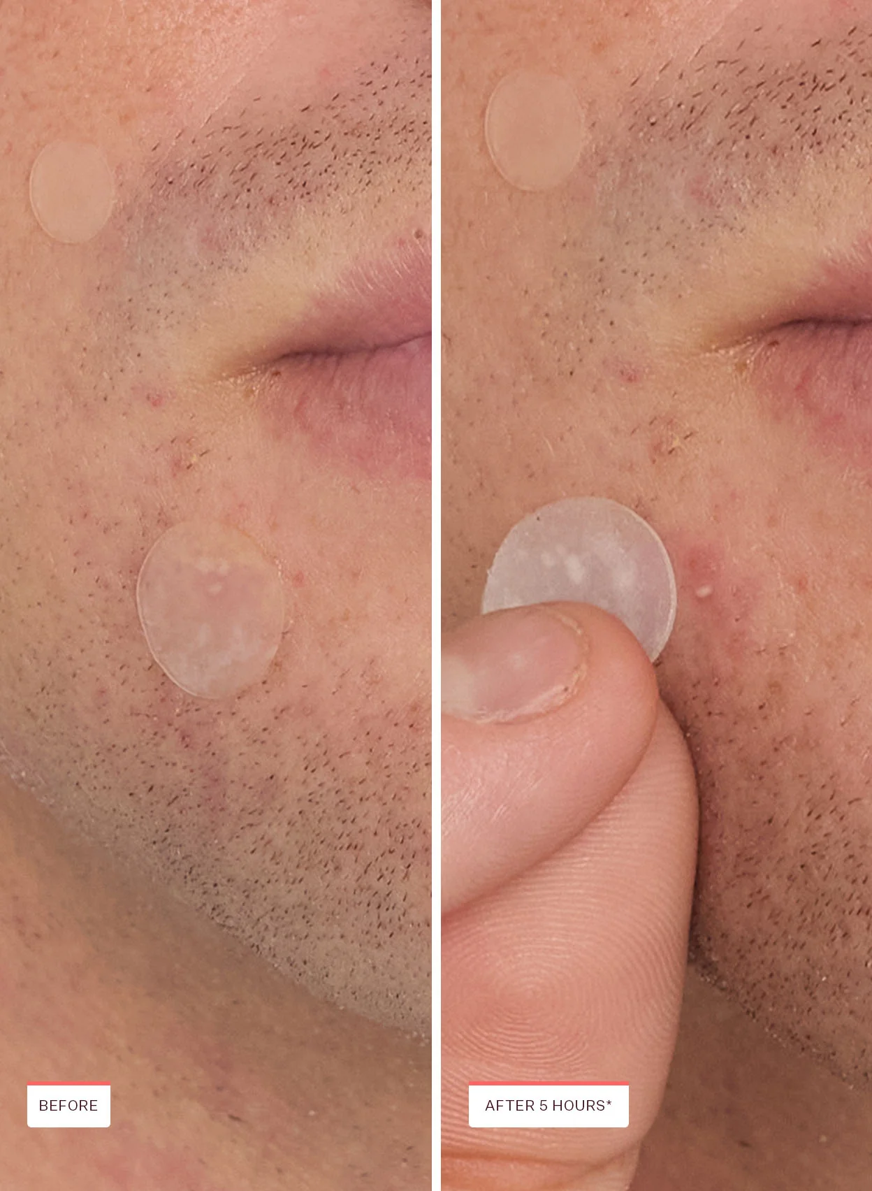 Acne Spot Treatment Trio - Image 7