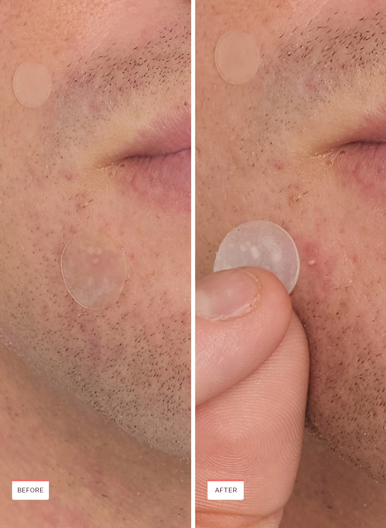 Acne Spot Dots - Image 7